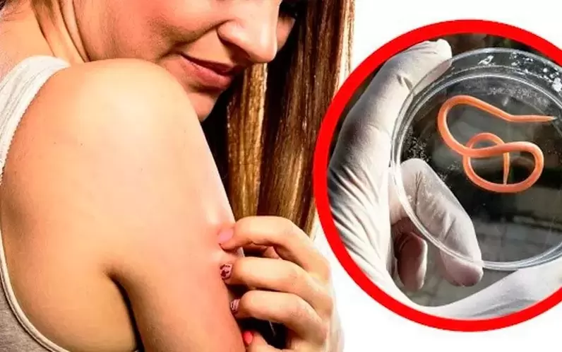 由于体内寄生虫引起的瘙痒和刺激