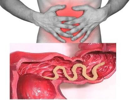 慢性蠕虫病的迹象是消化不良的肠病