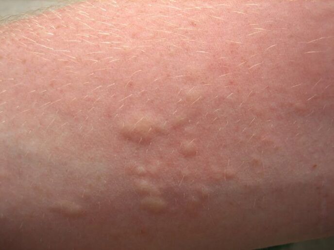 瘙痒的过敏性皮疹可能是as虫病的症状