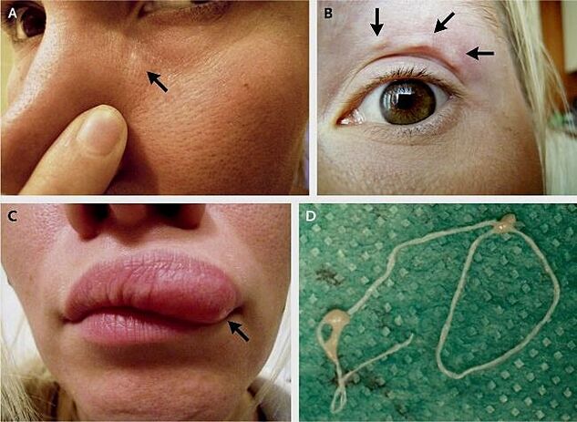 面部恶丝虫病的主要表现